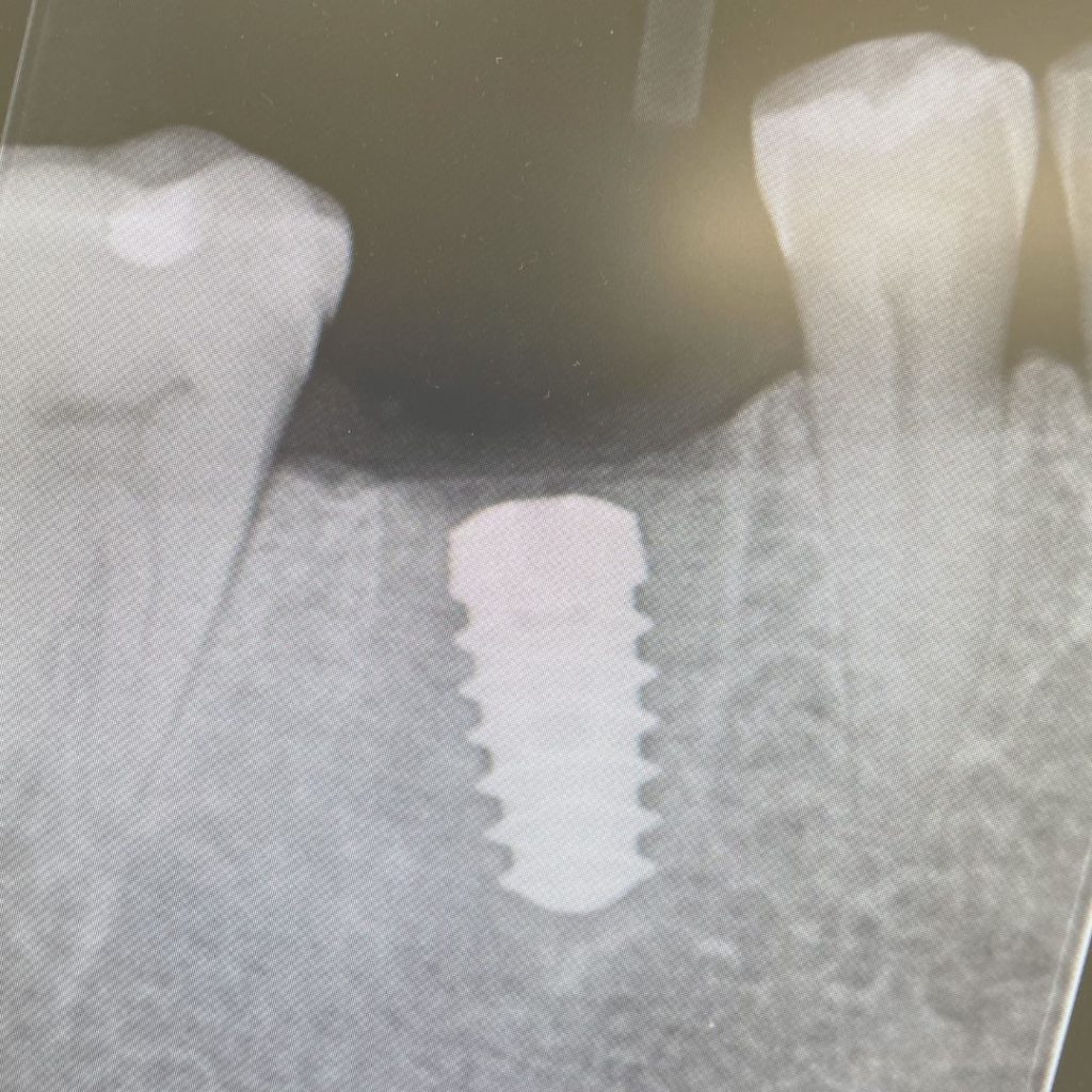 Impianto dentale a Novi Ligure - Gullo Vivaldi