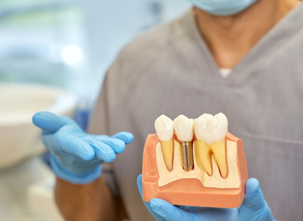 Che cos’è l’implantologia dentale? Le domande più frequenti 1 che cos'è l'implantologia dentale