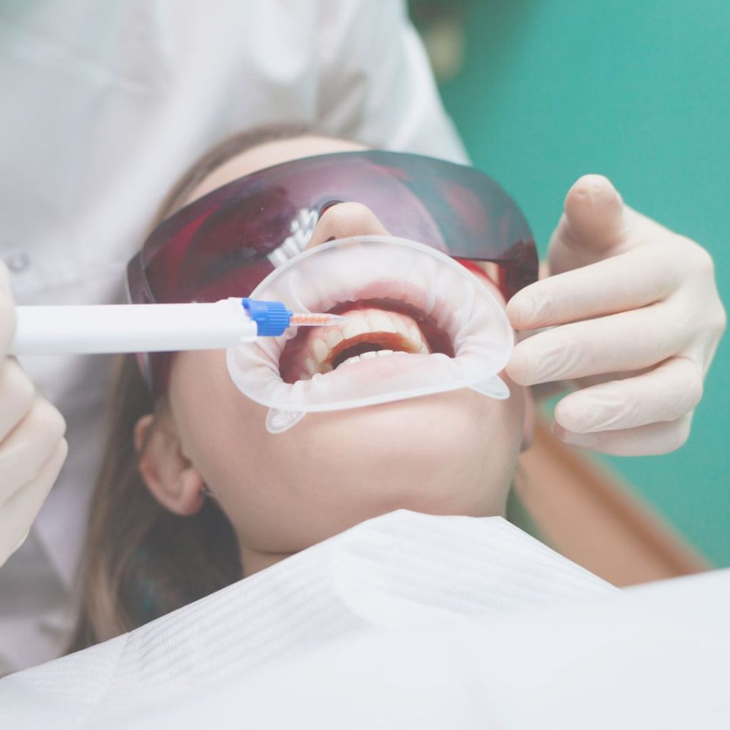 sbiancamento dentale a Novi Ligure
